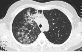 17句话总结肺部感染的影像诊断，堪称图谱级！