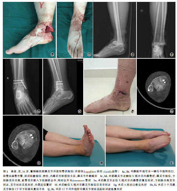 Ⅰ期清创内固定治疗踝关节开放性Logsplitter损伤1例
