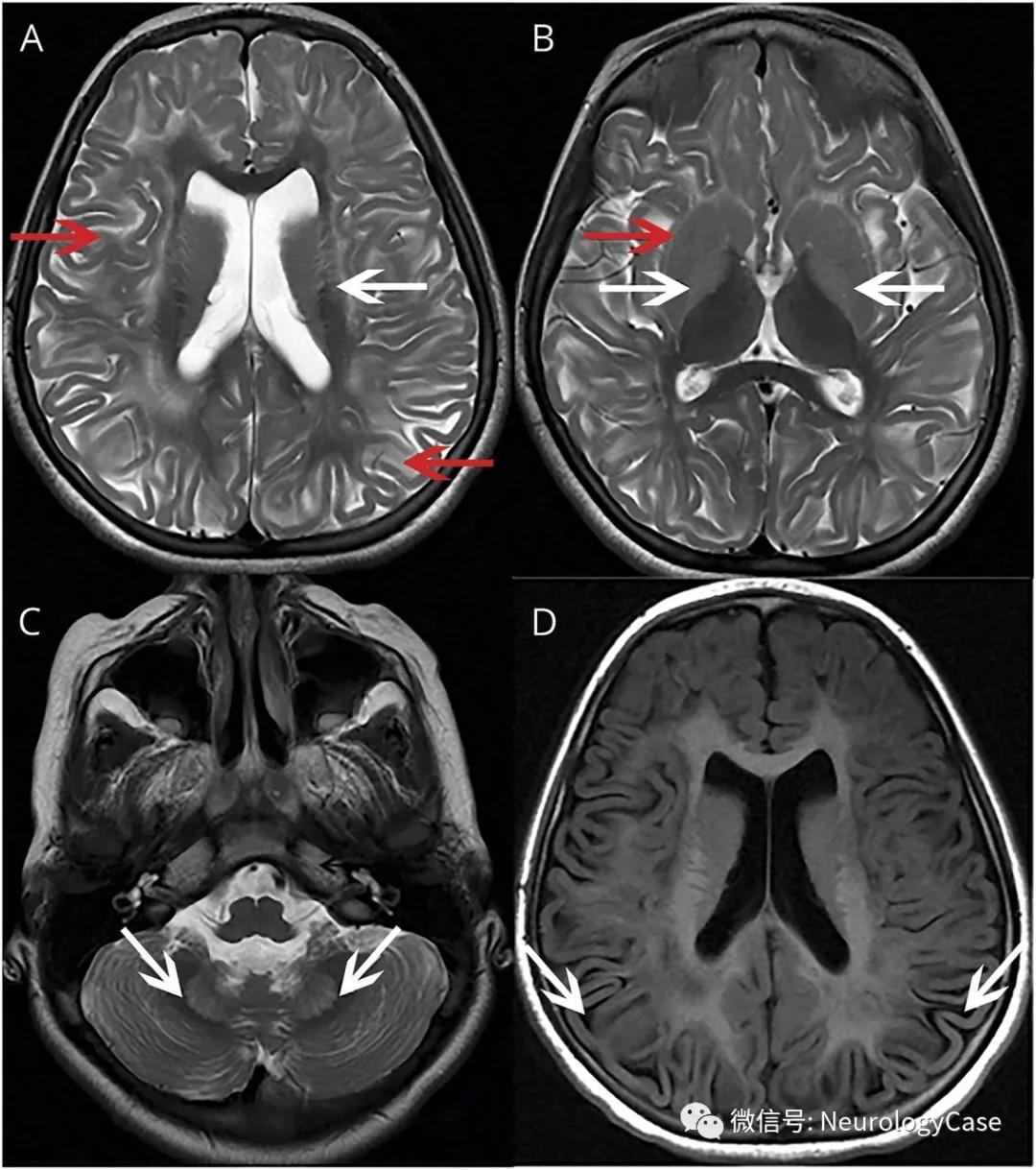 Neurology：L-2-羟基戊二酸尿症所致代谢性脑白质病的影像学表现