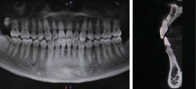PRF联合GBR在前牙即刻种植中的应用1例