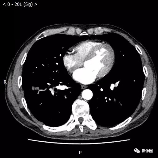 周围型肺癌x线图片图片