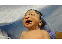 新生儿黄疸发病率逐年上升 专家建议及时干预