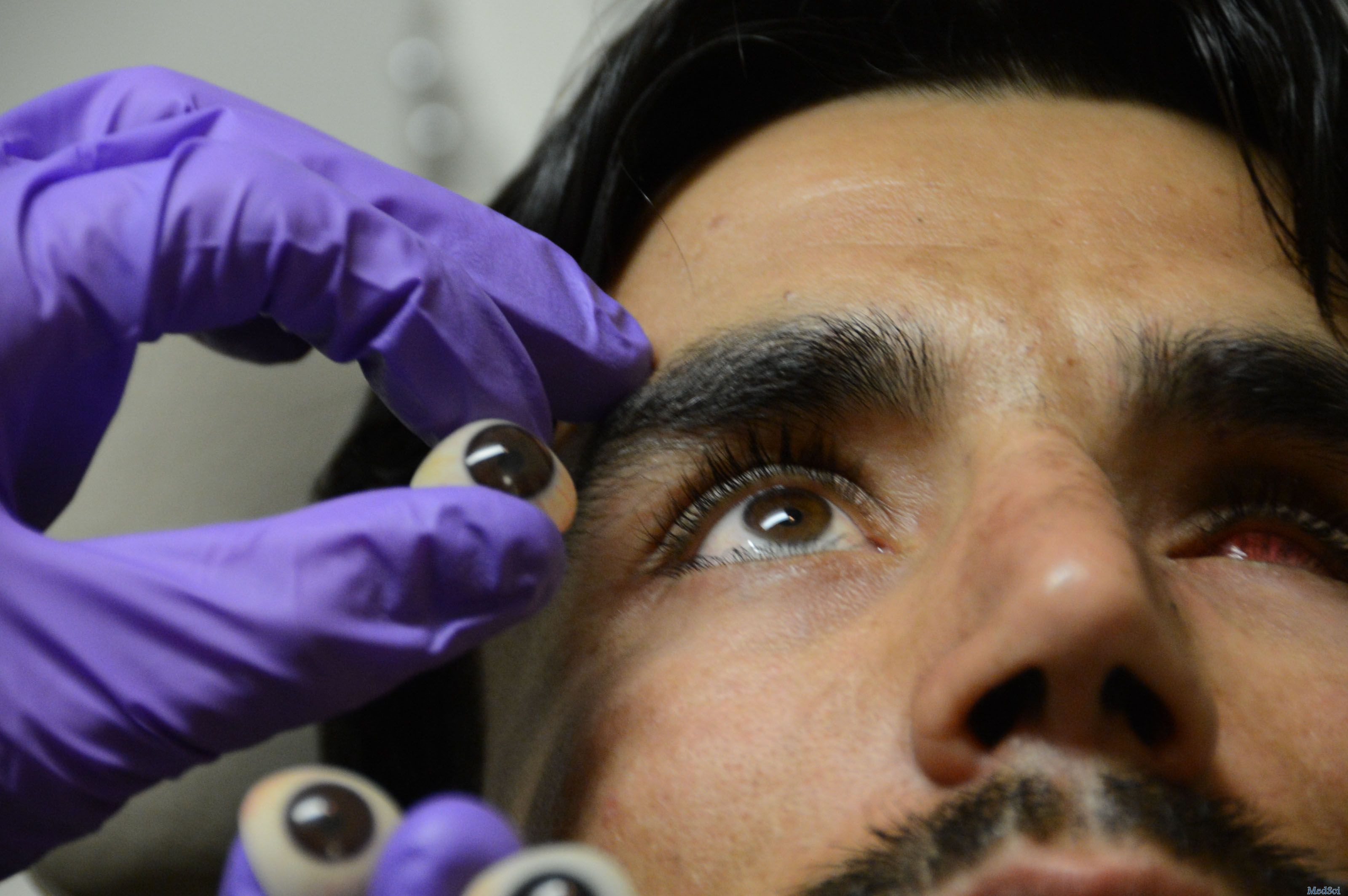 Ophthalmic Plast Reconstr Surg：可吸收植入异物可以引起眼眶组织炎症
