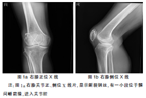 自拟下肢损伤熏洗方治疗髌骨骨折术后钢丝断裂进关节腔1例