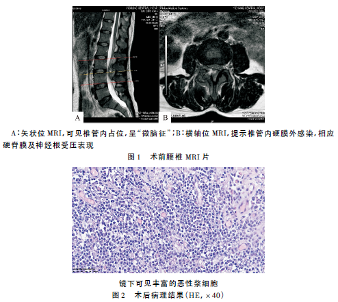 骨孤立性浆细胞瘤误诊误治为脊柱<font color="red">结核</font>1例