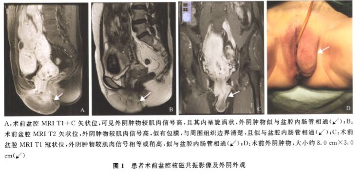 外阴侵袭性血管粘液瘤累及盆腔伴子宫肌瘤1例