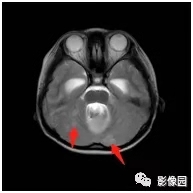 小脑蚓部髓母细胞瘤伴软脑膜转移1例