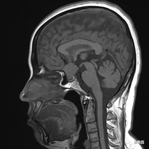 鞍结节脑膜瘤影像1例