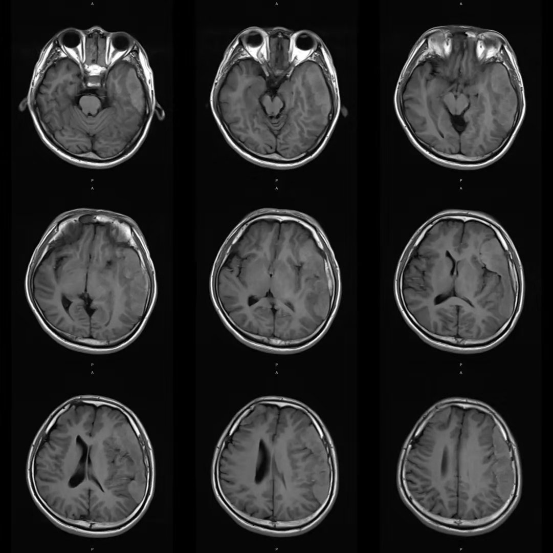 MRI诊断为<font color="red">脑膜瘤</font>，但最后却是这个病！