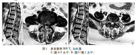 腰椎管狭窄症合并左骶髂关节弥漫性大B细胞淋巴瘤1例