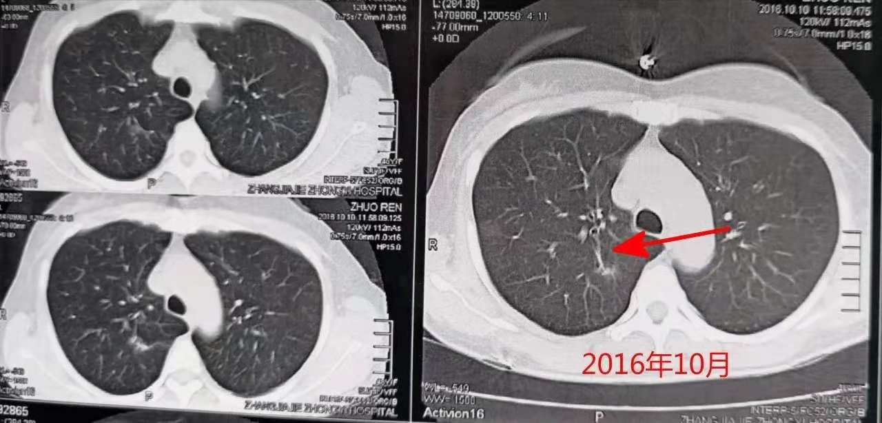 发现肺部磨玻璃样结节怎么<font color="red">办</font>，会不会是肺癌？
