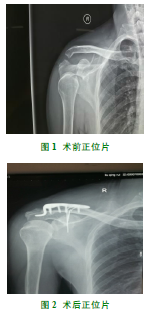 肩胛骨骨折合并肩锁关节脱位的手术治疗1例