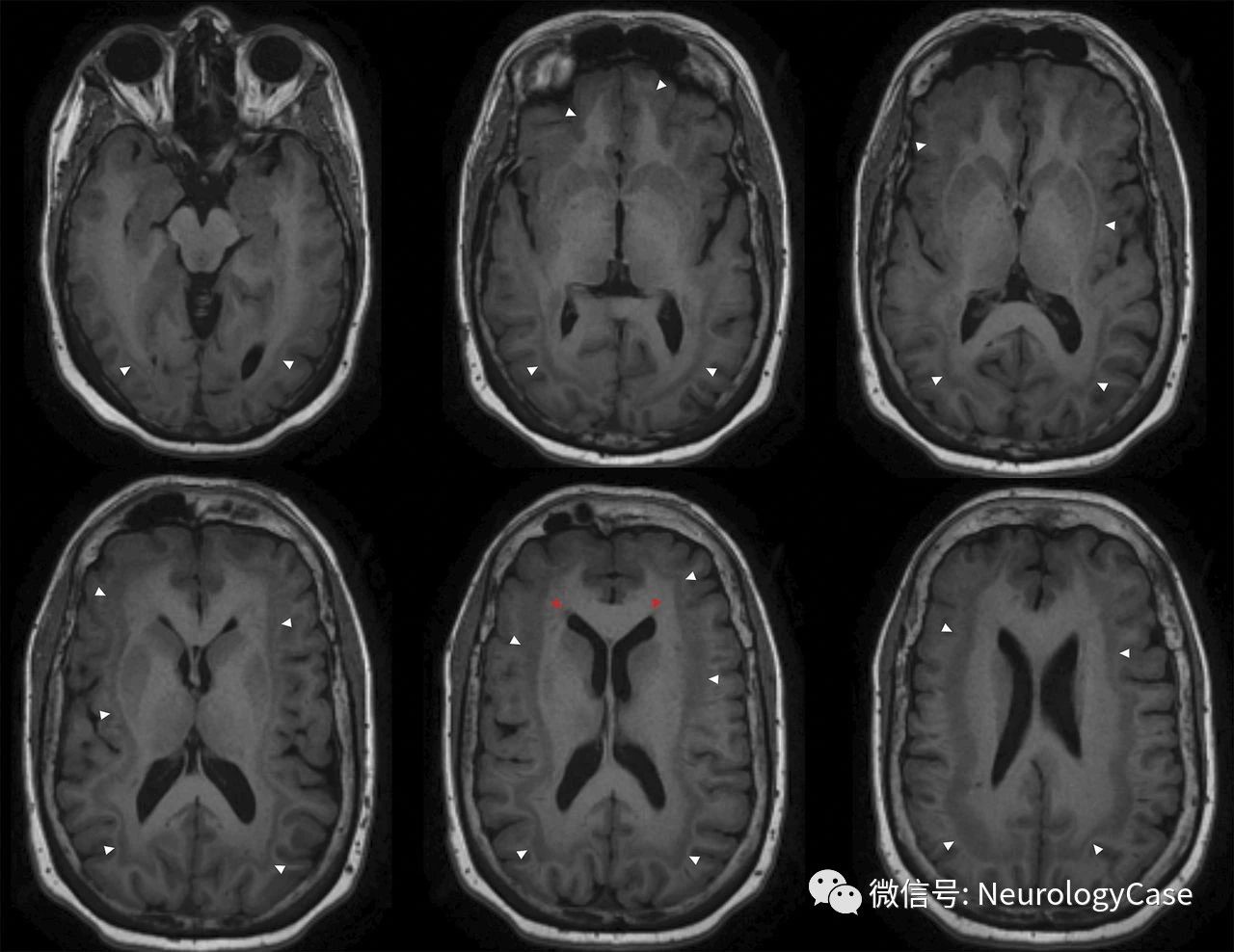 Neurology：双皮层：成人罕见诊断