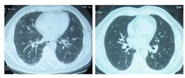 症状很像慢阻肺，许多患者戒了烟就能康复……呼吸性细支气管炎伴间质性肺疾病鉴别诊断难在哪？