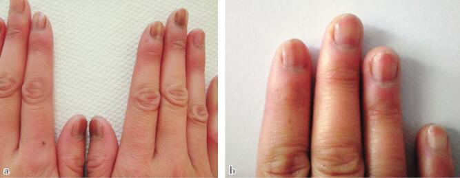 多个手指甲出现褐色纵行条带 能看出是什么病吗？