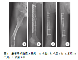 股骨中段骨促结缔组织增生性纤维瘤并病理性骨折一例