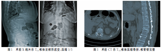 T12椎体压缩性骨折经皮椎体成形术后椎管内硬膜外血肿1例