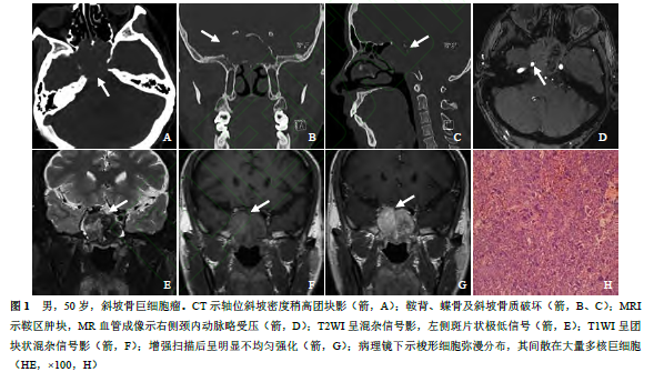 斜坡<font color="red">骨</font><font color="red">巨细胞</font><font color="red">瘤</font>1例