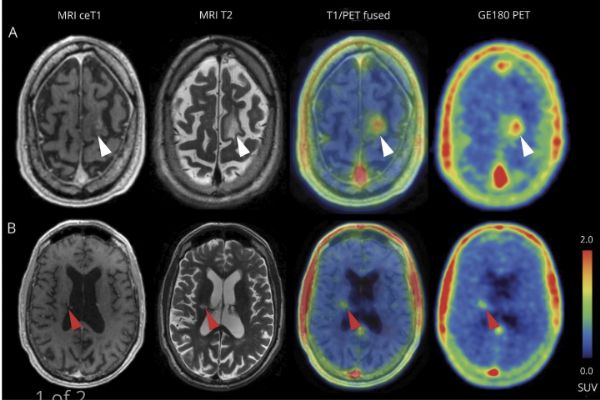Neurology：TSPO PET 有助于诊断 CNS <font color="red">血管炎</font>