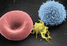 CAR-T治疗复发难治急性B淋巴细胞白血病缓解率高