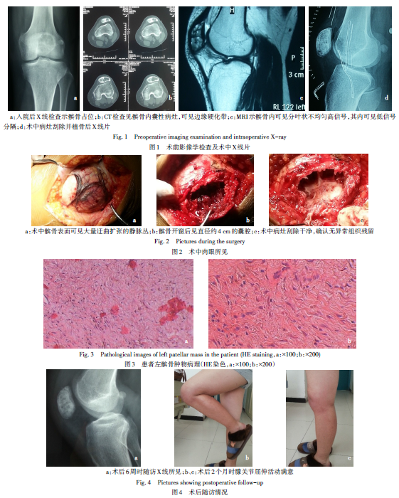 股骨非骨化性纤维瘤图片
