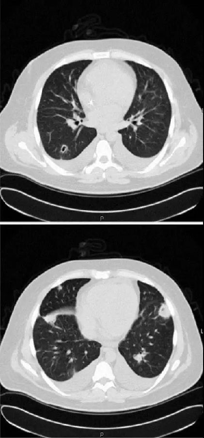 肺部感染背后的源头 | 病例分享