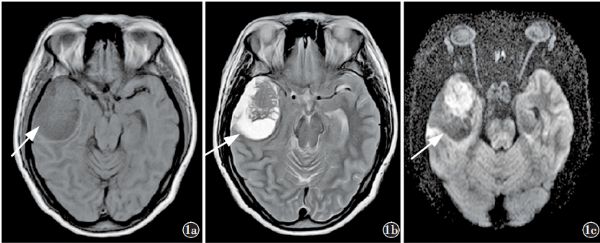 原发性颅内尤文肉瘤/原始神经外胚层肿瘤一例