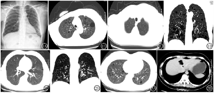 肺<font color="red">淋巴管</font>肌瘤病的CT诊断3例