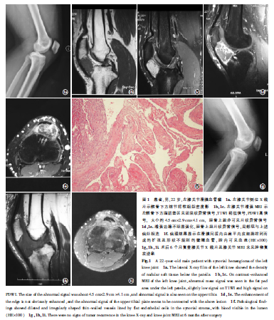 膝关节滑膜血管瘤1例
