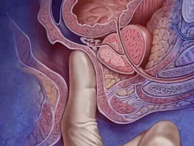 Clin Gastroenterology H： 布地奈德栓剂治疗急性溃疡性直肠炎是有效和安全的