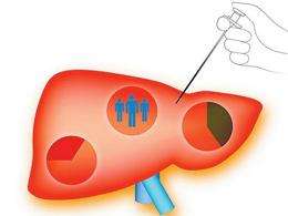 Clin Gastroenterology H： <font color="red">乙型</font>肝炎核心蛋白抗体血清水平与核苷酸（t）类似物治疗中断后的临床复发相关