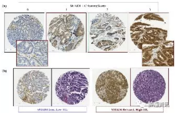 Clin Cancer Res：结直肠癌有前途的疗效预测和预后标志物：SMAD4缺失与复发、缺少免疫浸润和化疗耐药相关