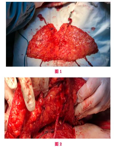 应用浅表静脉引流腹壁下动脉穿支皮瓣（DIEP）乳房再造术