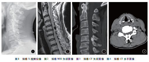 颈后路单节段双开门椎管<font color="red">成形术</font>治疗黄韧带钙化症一例