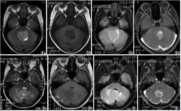 成人小脑中线区髓母细胞瘤的MRI<font color="red">表现</font>