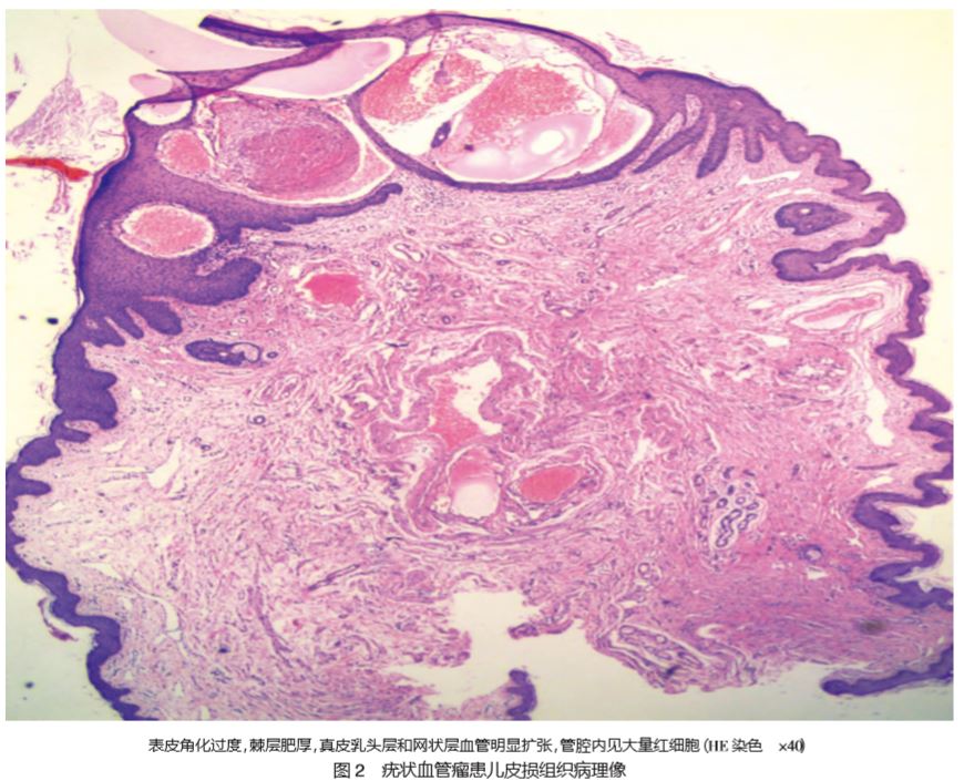 阴囊疣状血管瘤1例