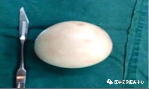 腹部CT发现了“熟鸡蛋”，原来是它