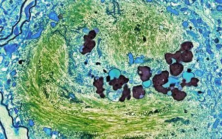 Cell Stem Cell: 厉害了！他汀可通过降低阿尔茨海默病神经细胞中胆固醇酯水平，减少磷酸化Tau蛋白，治疗AD又有了新靶点
