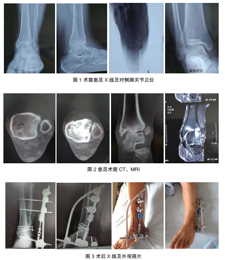 陈旧性下胫腓联合不稳定合并踝关节骨性关节炎1例