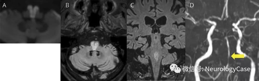 Neurology：闭锁综合征患者的影像学“心形”<font color="red">外观</font>