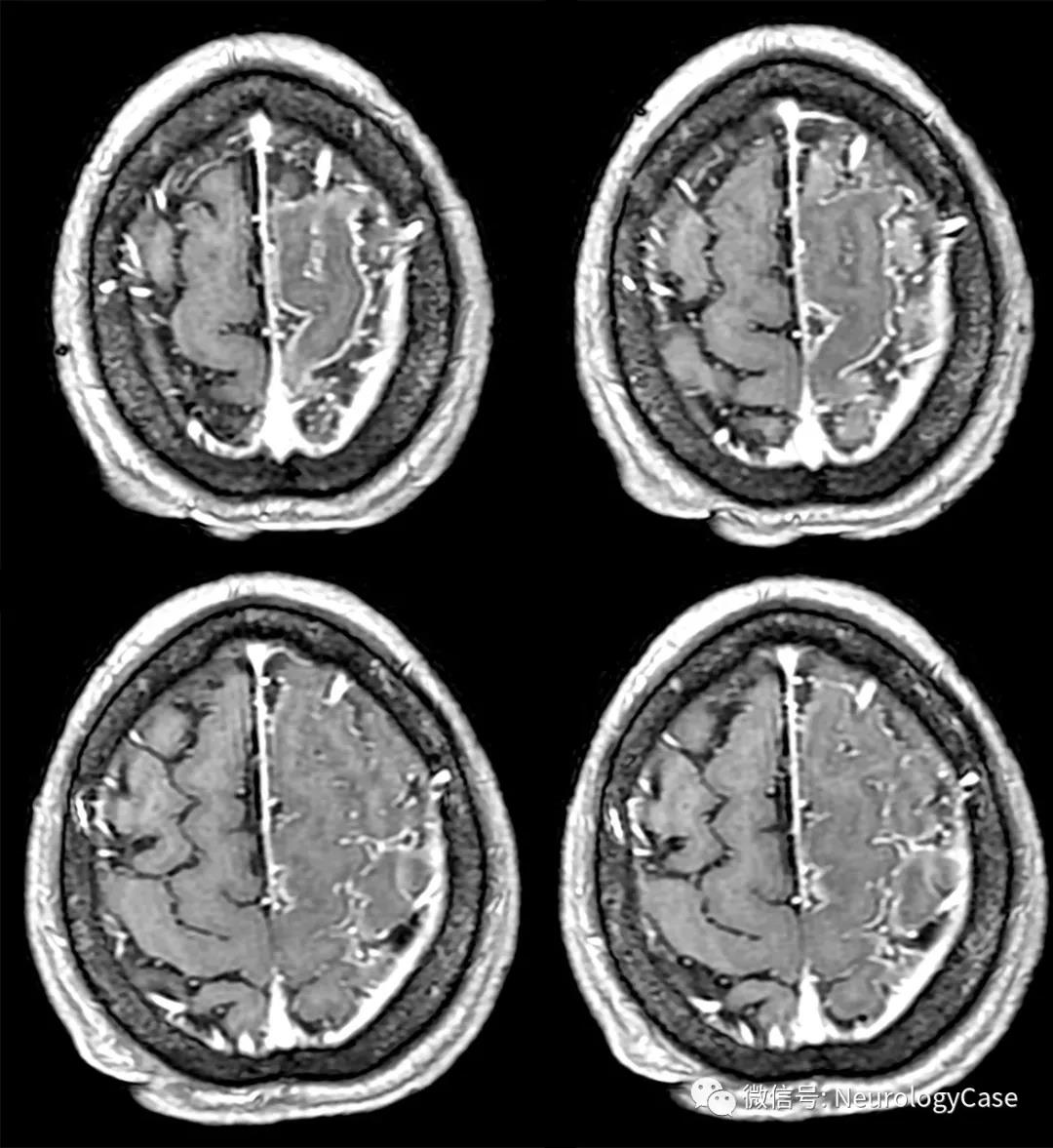 Neurology：貌似急性缺血性卒中的半侧脑膜炎