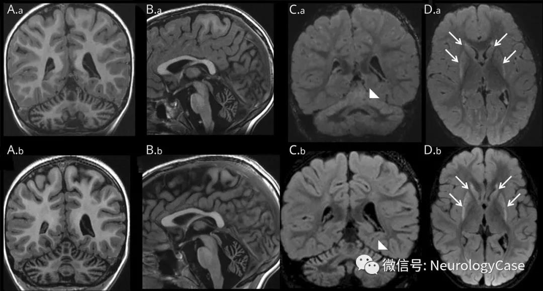 Neurology病例：<font color="red">Leigh</font>样特征扩展了PMPCA相关疾病的影像表现