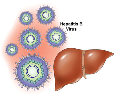 Hepatology：与单纯HCV感染者相比，HIV/HCV感染的肝硬化患者不再具有更高的肝癌或晚期肝病风险