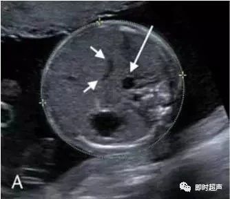 超声图解胎儿脐静脉异常
