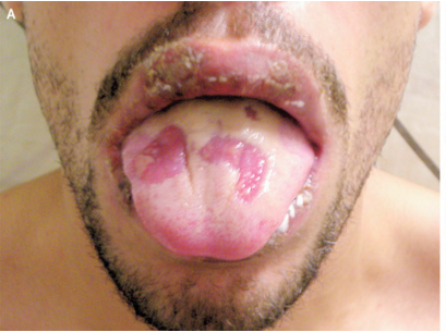 NEJM：白塞病所致的口腔和生殖器溃疡-病例报道