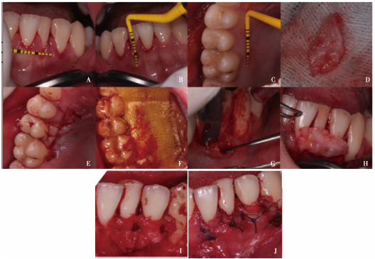 上皮下结缔组织移植术治疗正畸后牙龈退缩1例