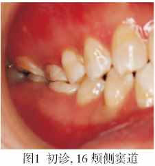 右侧上颌第一磨牙MB2根管1例