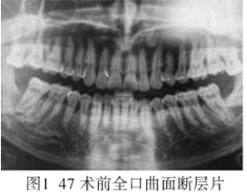 下颌第二<font color="red">磨牙</font>远中骨缺损致牙周牙髓联合病变1例