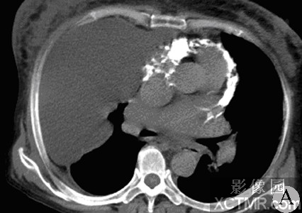 缩窄性心包炎CT病例影像诊断分析(图文)