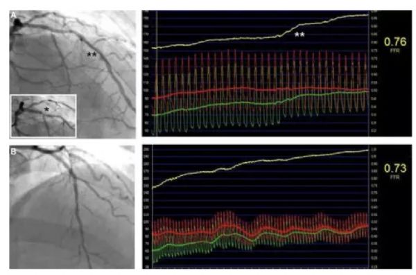 Circ Cardiovasc Inte：支架置入术后的影像学和生理学评估